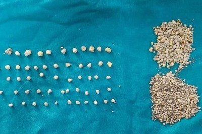 Chennai Doctors Remove Over 1200 Gallstones From Woman, Photos Go Viral