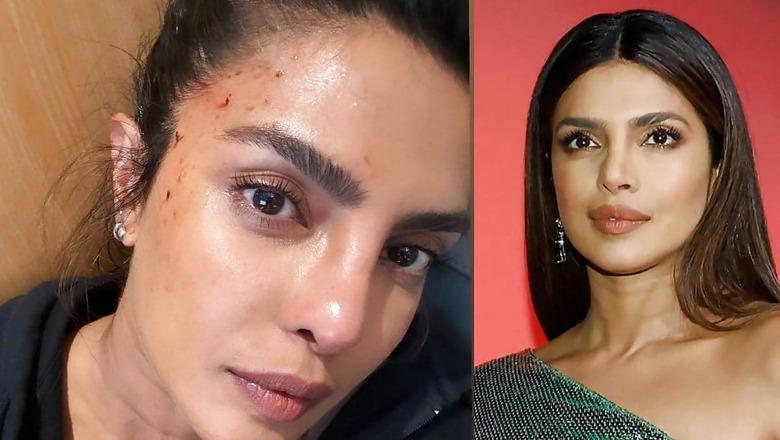 Priyanka Chopra Gets Injured on Heads of State Set, Shares Photo Of Bloodied Forehead | See Here