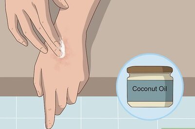 How to Treat Eczema Naturally