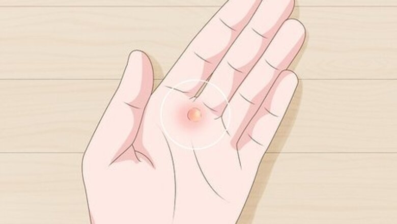 How to Heal Blisters