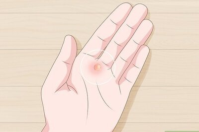 How to Heal Blisters