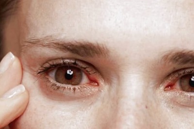 Simple Tips To Prevent Dry Eye Discomfort