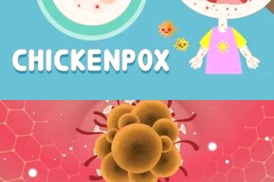 Monkeypox Vs Chickenpox: Know How You Can Differentiate The Symptoms