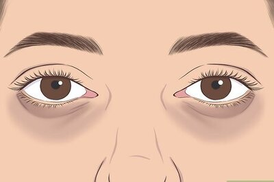 What Are the Different Kinds of Dark Circles Under Your Eyes?