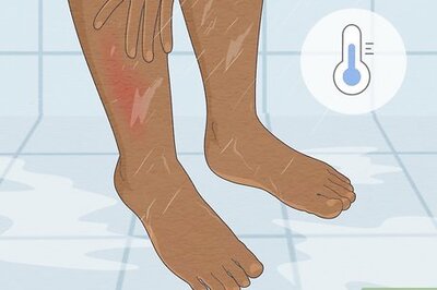 How to Get Rid of a Rash from Nair