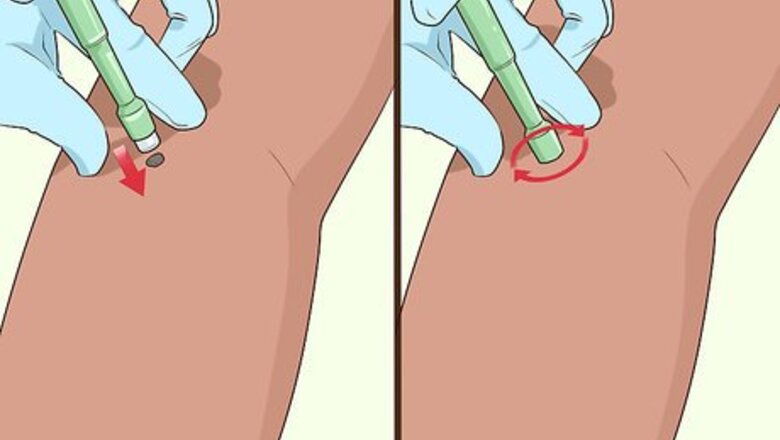 How to Undergo a Mole Biopsy