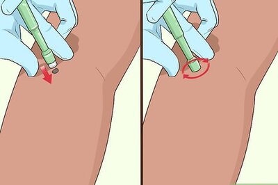 How to Undergo a Mole Biopsy
