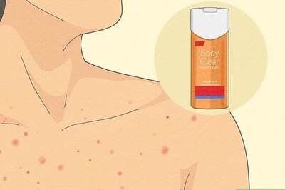 How to Get Rid of Acne on Your Chest at Home