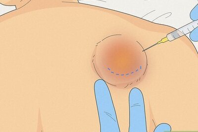 How to Drain a Cyst