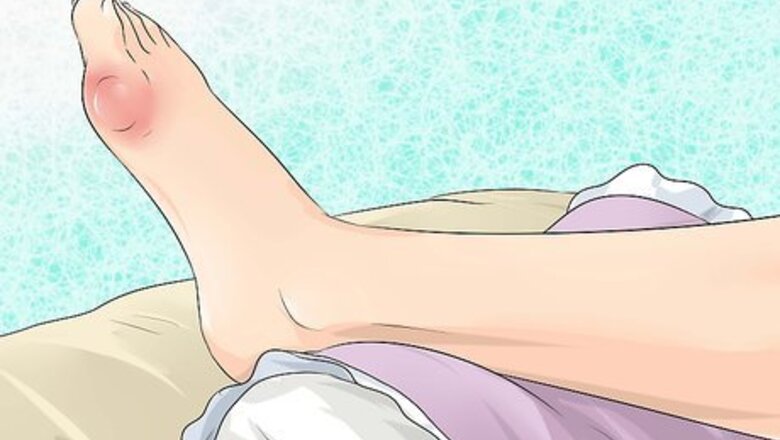 How to Get Gout Relief at Home