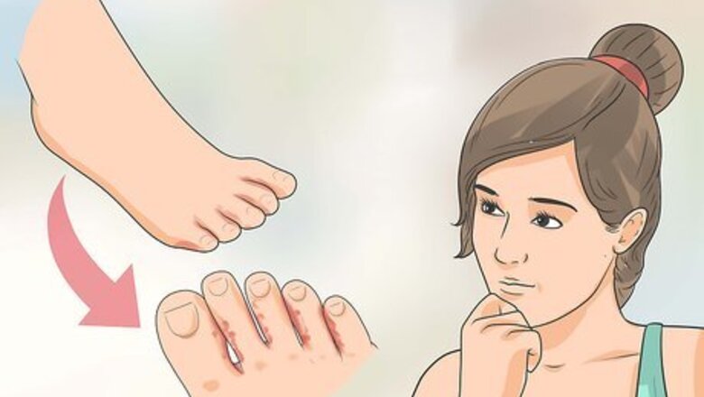 How to Treat Athlete's Foot