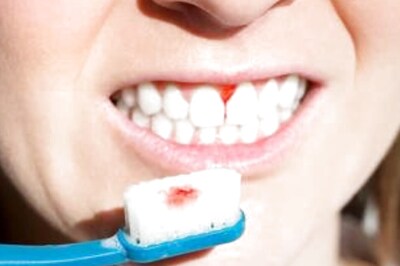 5 Oral Hygiene Practices to Avoid Bleeding Gums And Cavities