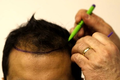 Considering A Hair Transplant? Keep These Things In Mind Before Taking The Big Decision