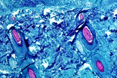 Monkeypox Outbreak: WHO to Convene Emergency Meeting, Say Reports | All You Need to Know