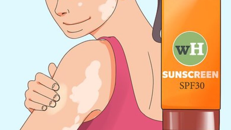 How to Prevent Vitiligo