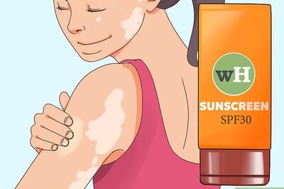 How to Prevent Vitiligo