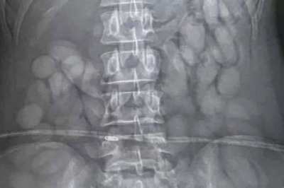 Namibian Woman, Who Swallowed Over 60 Cocaine Bullets, Arrested At Johannesburg Airport