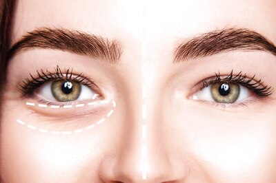 Tired of Bags Under Your Eyes? Try These Easy Tips to Get Rid of Dark Circles Permanently