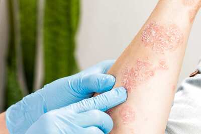 Vitamin D for Psoriasis: Benefits, Uses, and All You Need to Know