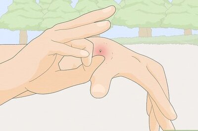 How to Treat a Bee Sting