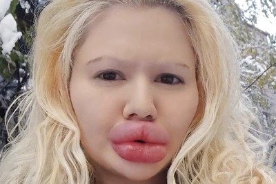 Woman Undergoes 4 Surgeries For Bigger Lips, Now Finding It Hard To Find A Partner