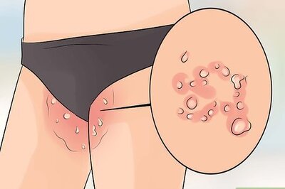 How to Treat Jock Itch