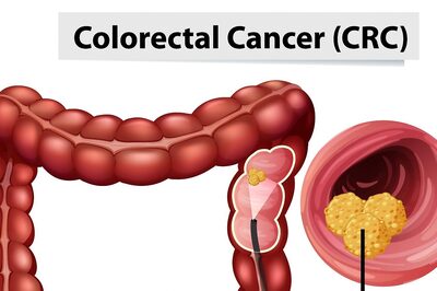 Colorectal Cancer: Early Screening, Prevention, Symptoms And Treatment