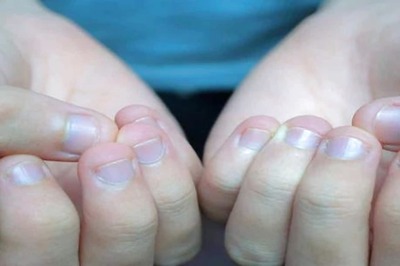 Skincare Tips: Get Rid of Peeling Cuticles With These Easy Home Remedies