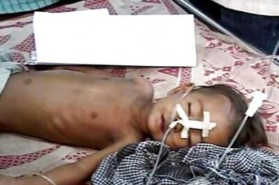 Encephalitis claims 3 more lives; death toll climbs to 380