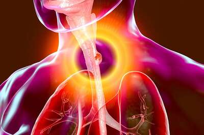 Esophageal Cancer: Throat Cancer Warning Signs You Should Know