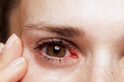 Common Eye Infections During Monsoon And Their Treatments