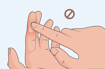 How to Treat a Hot Glue Burn