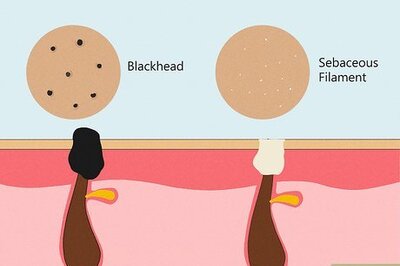 Sebaceous Filaments: What They Are & How to Reduce Them